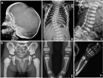 A Null Mutation of TNFRSF11A Causes Dysosteosclerosis, Not Osteopetrosis